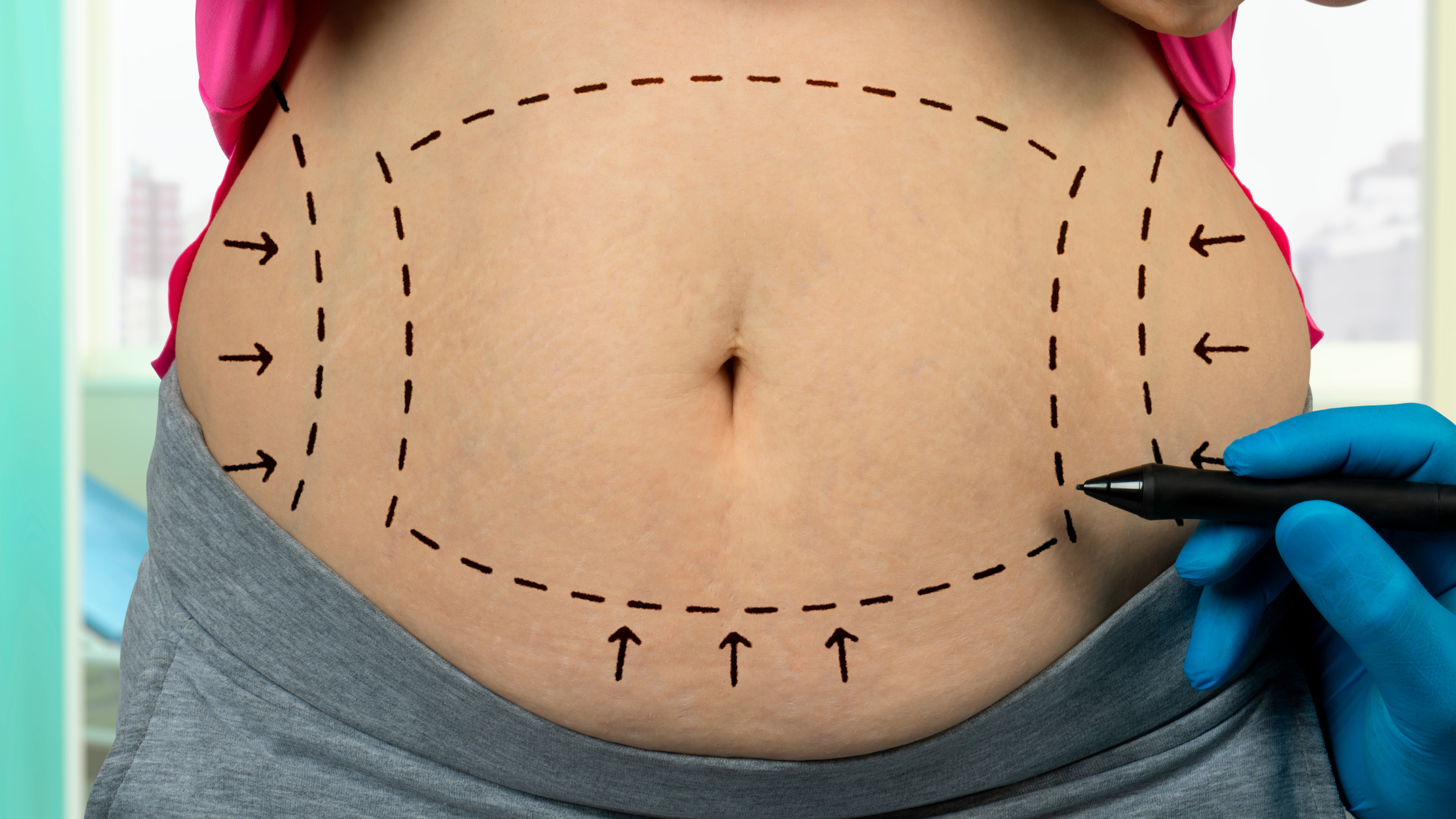 Your Liposuction Recovery with Cutting-Edge Tips!